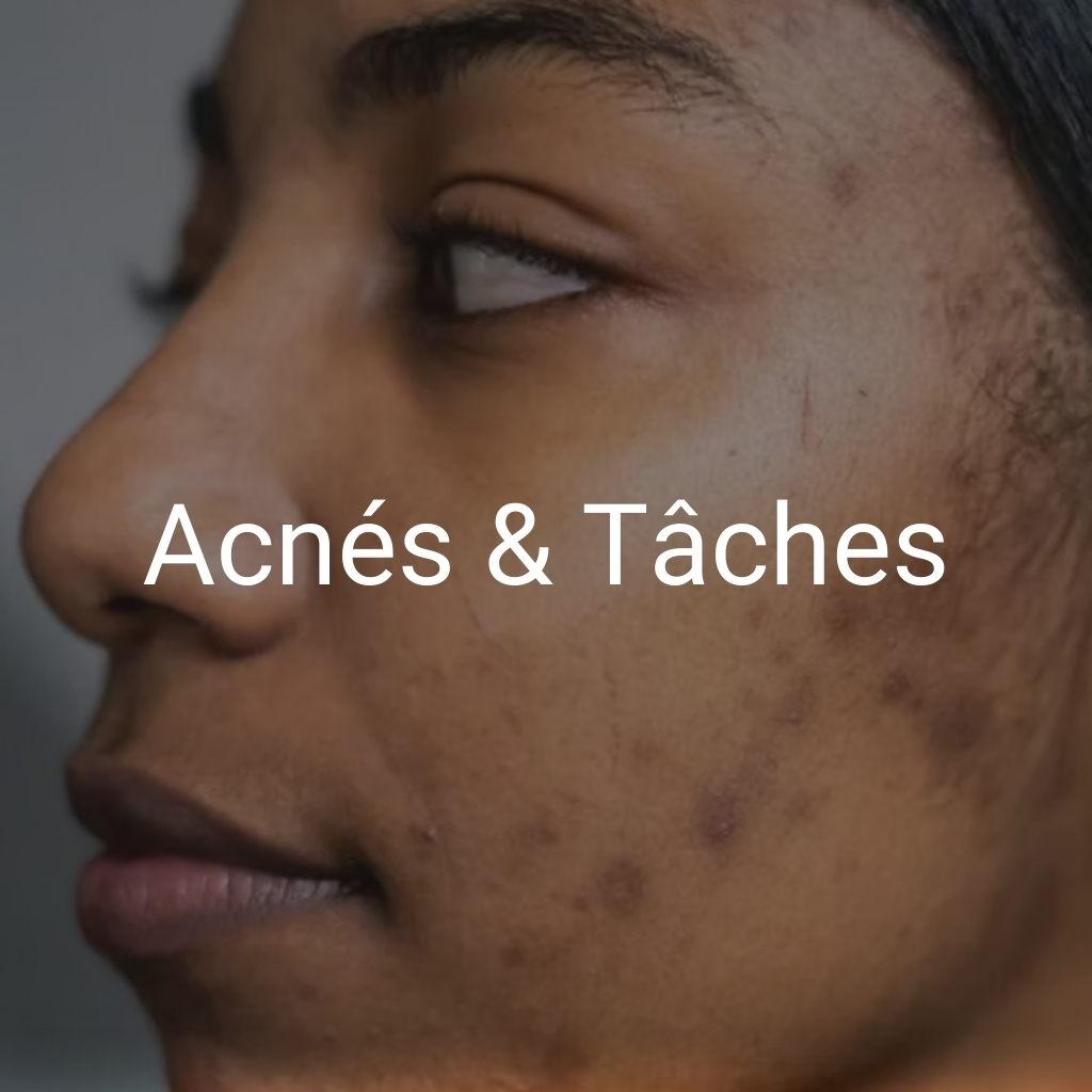Acnés et Tâches